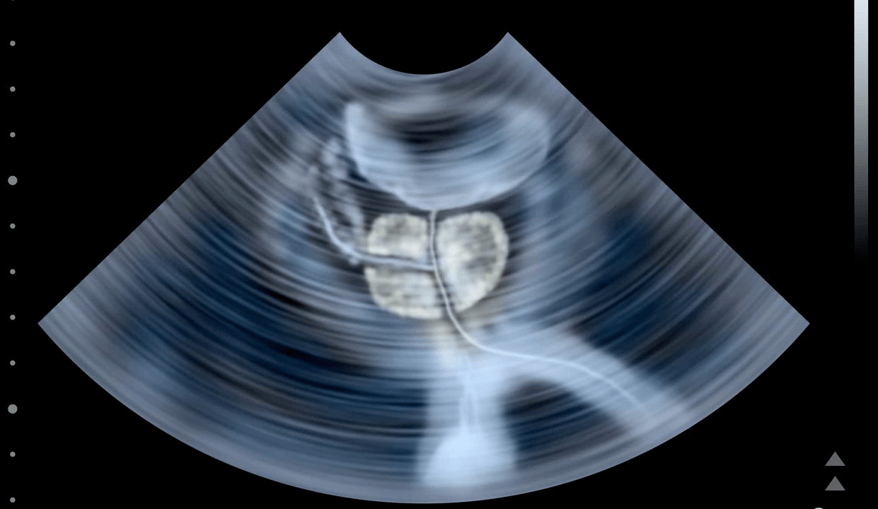 Ultrasound examination of calculus prostatitis