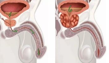prostatitis