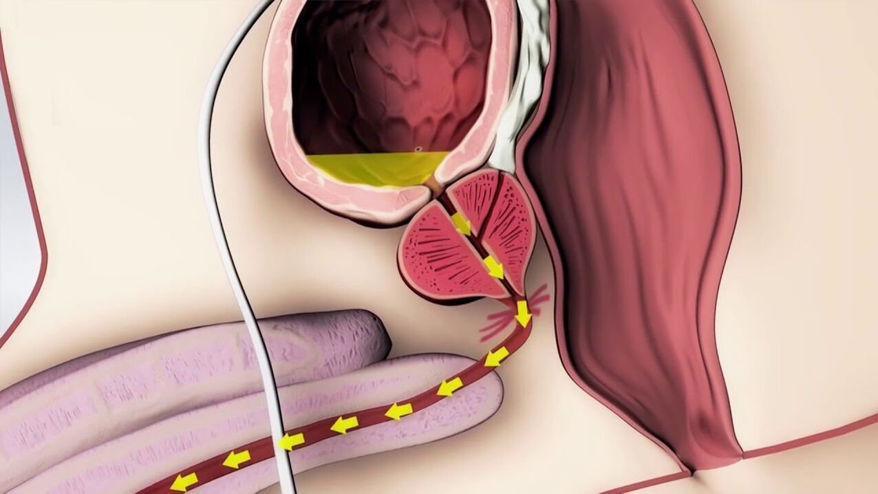 prostatitis