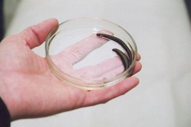 For men with prostatitis, leech therapy has been shown to be effective