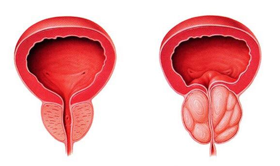 Normal and inflamed prostate (prostatitis)