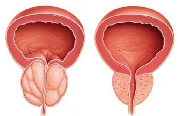 Normal and enlarged prostate with prostatitis