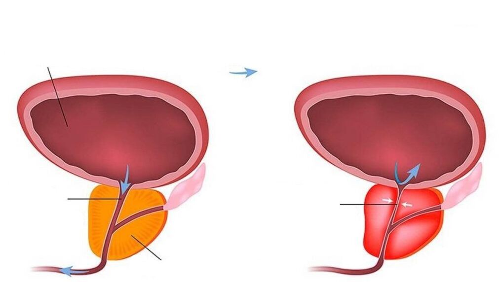 Normal and inflamed prostate